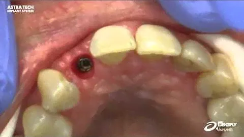 TiDesign™ EV Triangular – Installation | Dentsply Sirona